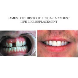 Dental-Impant-before-and-after