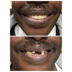 Dental-Impant-before-and-after