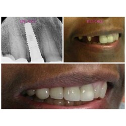 dental-implant-before-after-photos-baltimore-sedation-dentistry